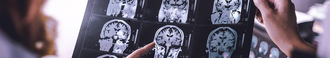 GliMEpi: nieuw type MRI scan voor hersentumoren en epilepsie ￼